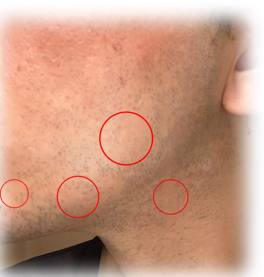 トリアレーザー脱毛器4xの使用後、髭の変化